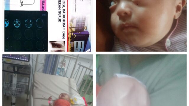 Donasi Untuk Rukaya,Bayi menderita Hydrocephalus " Rp 10.000 atau berikan kami Doa"